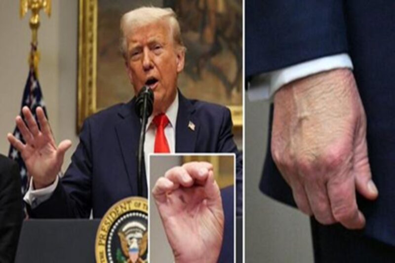 டொனால்ட் டிரம்பின் உடல்நலம் குறித்து அதிகரிக்கும் அச்சம்!