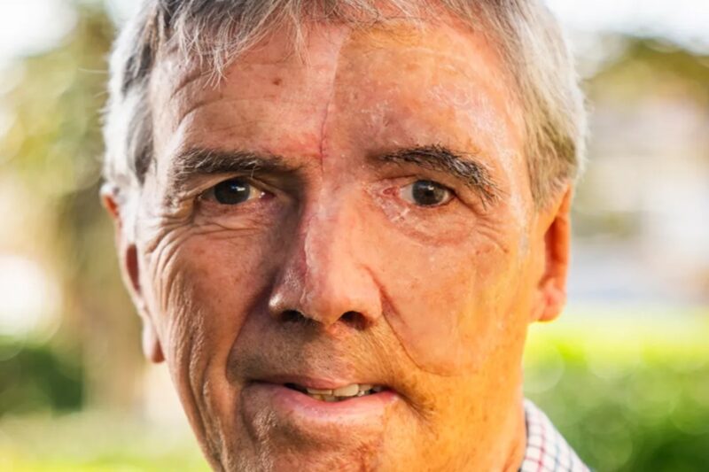 மருத்துவ அதிசயம்: விபத்தில் சிதைந்த முகத்திற்கு ‘3D பிரிண்டட் முகம்’!